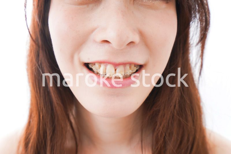歯列矯正をする若い女性