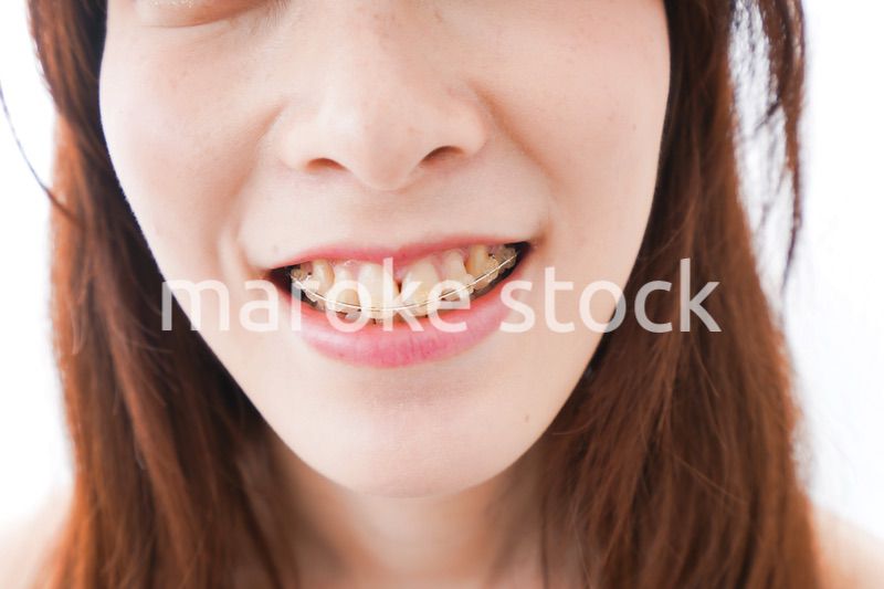 歯列矯正をする若い女性