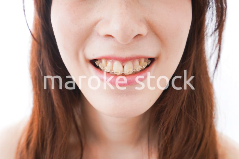 歯列矯正をする若い女性