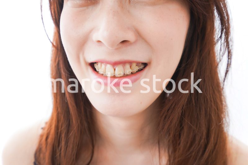 歯列矯正をする若い女性