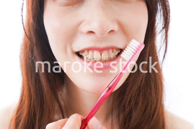 歯列矯正をする若い女性